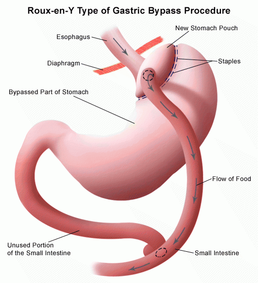 gastric-bypass