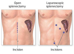 splenektomi
