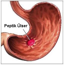 peptik-ulser