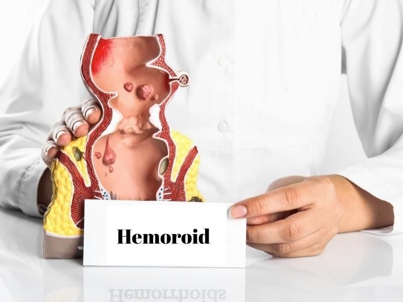 hemoroid-lastik-bant-uygulamasi-nasil-yapilir-